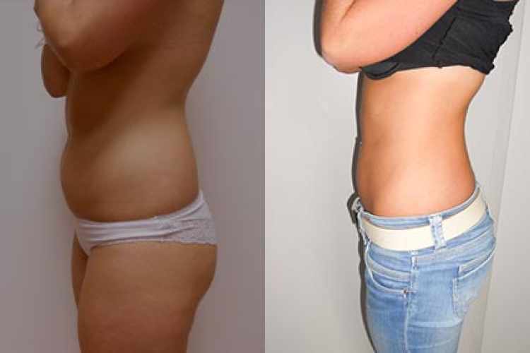 před a po liposukce