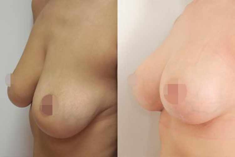 Fotogalerie - modelace prsou s augmentací před a po