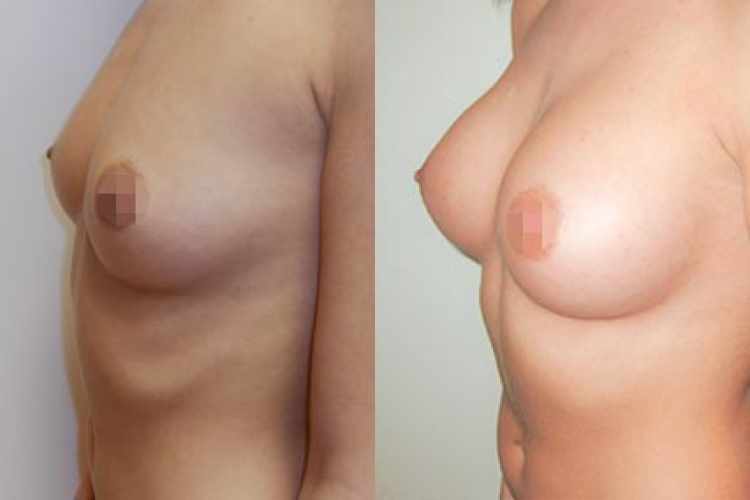 zvětšení prsou před a po