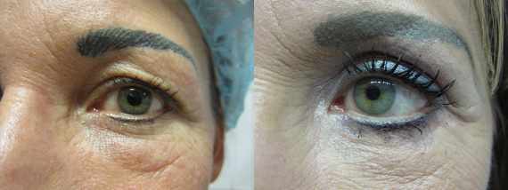 Operace očních víček před a po