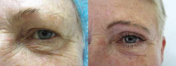 Fotogalerie - Operace očních víček před a po