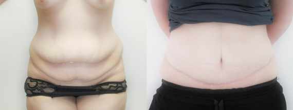 plastika břicha (Abdominoplastika) před a po