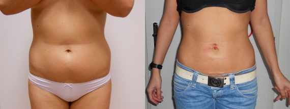 Foto před a po liposukce