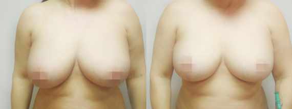 Fotogalerie - modelace prsou před a po