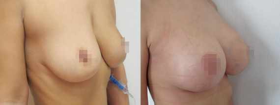 modelace prsou s augmentací před a po