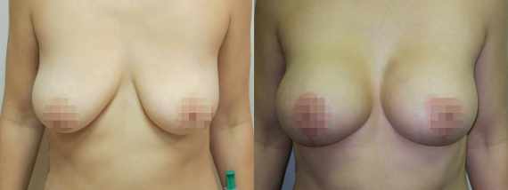 modelace prsou s augmentací před a po