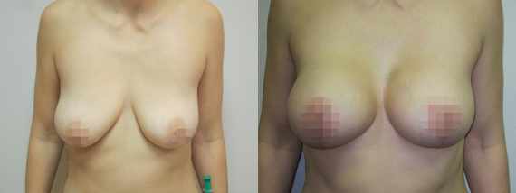 Augmentace s modelací prsou