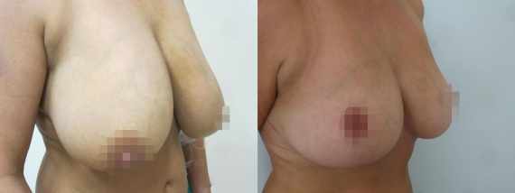 zmenšení prsou před a po